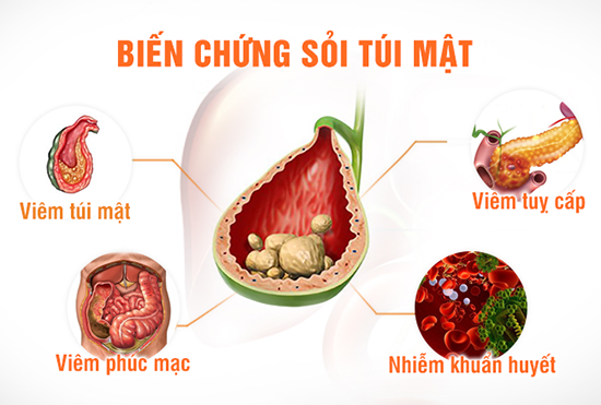 5 biện pháp phòng ngừa sỏi mật bạn cần thực hiện ngay